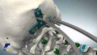 CASPIAN® Occipital Plate Product Animation [upl. by Lyris]