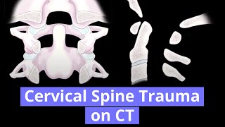 Cervical Spine Trauma on CT [upl. by Ataeb]