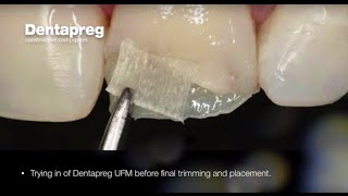 Restoration of Chipped Incisal Edge by Dr Dennis Hartlieb [upl. by Gomar]