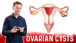 Ovarian Cysts Causes Symptoms amp Natural Treatment – DrBerg [upl. by Eillas368]