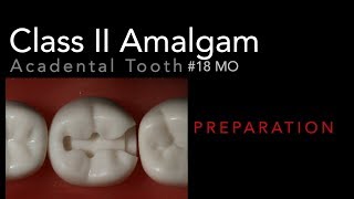 Class II Amalgam Preparation  18 MO Acadental Typodont [upl. by Clercq]