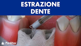 Estrazione dente – Conservazione del alveolo © [upl. by Yelrebmik563]