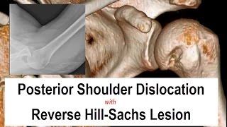 Posterior Shoulder Dislocation Reduction [upl. by Jobina959]