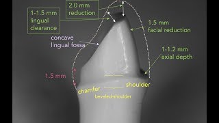 Anterior PFM Preparation  Dr Richard Stevenson [upl. by Adihsaar733]