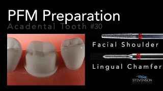 PFM Preparation  Acadental Tooth 30  Dr Richard Stevenson [upl. by Marmawke]