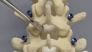 Posterior Lumbar Interbody Fusion PLIF spine surgery [upl. by Cyrus]