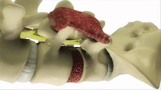 Transforaminal Lumbar Interbody Fusion TLIF  DePuy Videos [upl. by Cos]