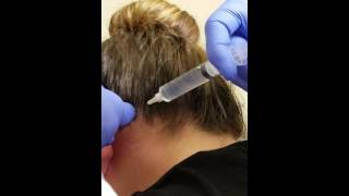 Bilateral Occipital Nerve Block [upl. by Fleta]