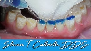 Bonding Worn Anterior Teeth  Dental Minute with Dr Steven T Cutbirth DDS [upl. by Alveta741]