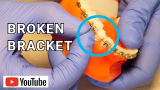 Broken Braces Broken Loose or Sliding Bracket What To Do [upl. by Sibell]