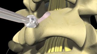 Low Back Pain Lumbar Laminectomy Surgery [upl. by Joashus848]