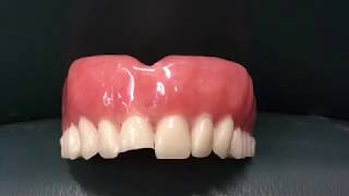 Denture tooth repair slideshow using Triad Gel [upl. by Airod]