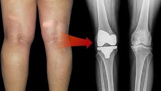 How to Treat a Bakers Cyst Behind the Knee  Top 5 Home Remedies for Bakers Cyst Behind the Knee [upl. by Roid]