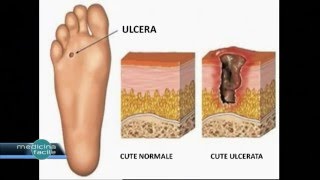 Medicina Facile  Curare il Piede diabetico [upl. by Dloreg]