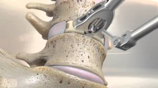 STALIF M™ MIDLINE II Surgical Technique Animation  Anterior Lumbar Interbody Fusion [upl. by Halyhs]