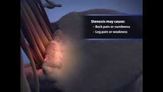 Spinal Stenosis [upl. by Merry]