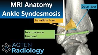 MRI Anatomy of Ankle Ligaments Syndesmosis [upl. by Conlon340]