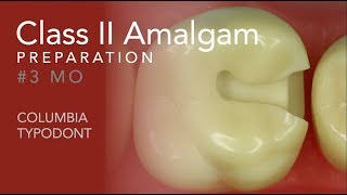 Class II Amalgam Preparation 3 MO [upl. by Reyna]